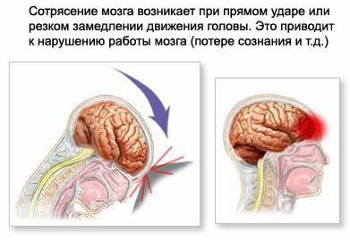 Механизм развития черепно-мозговой травмы