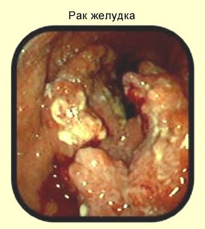 Рак желудка при эндоскопическом исследовании