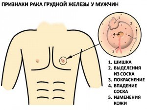 Симптомы рака грудной железы у мужчин