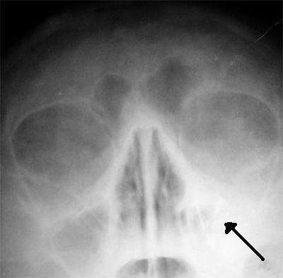 Рентгеновский снимок при гайморите