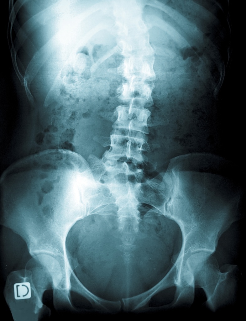 Рентгенограмма позвоночника при сколиозе