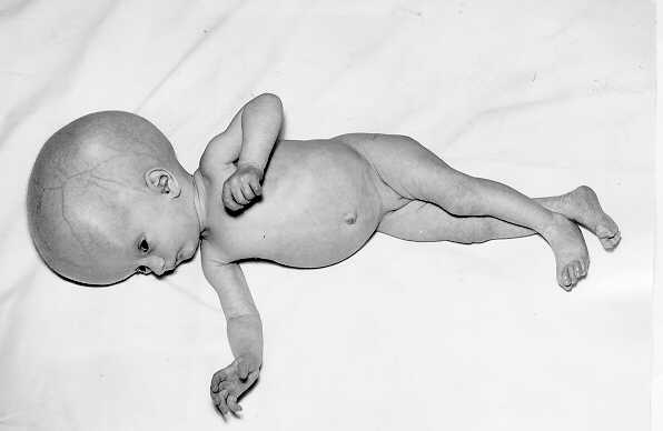 Ребенок с врожденным токсоплазмозом