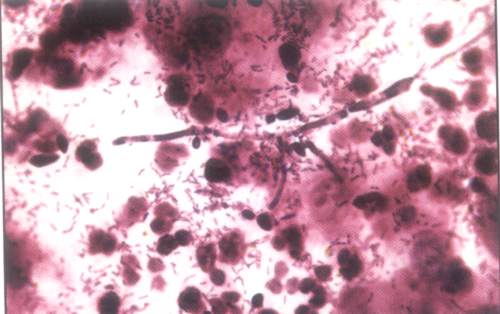 Микроскопическая кратина при вагините